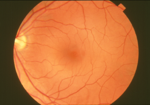 image tagged with fundus, normal retina