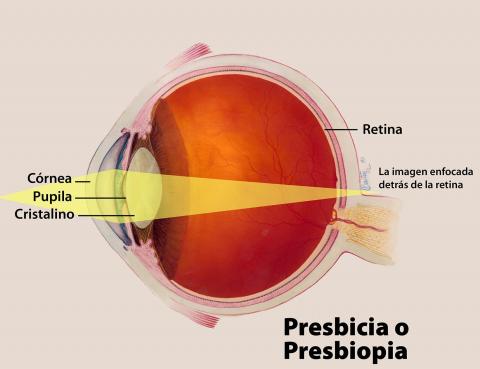 image tagged with presbiopia, anatomy, infographic, pupil, farsightedness, …;