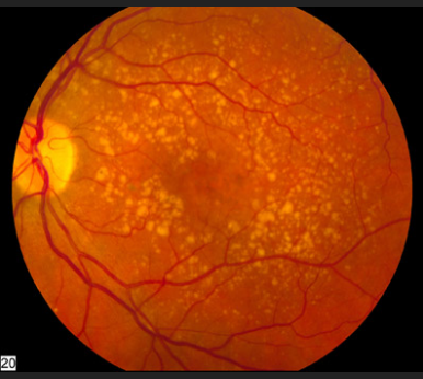 image tagged with microscope, age-related macular degeneration, eye, microscopic, science, …;