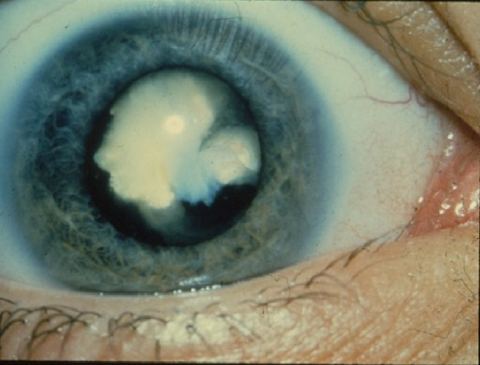 image tagged with cloudy lens, iris, congenital cataract, vision, cataract, …;