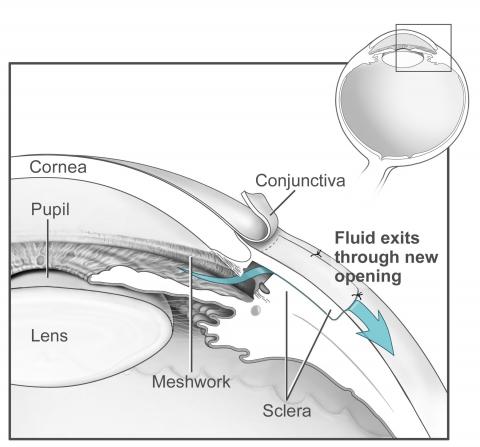 image tagged with anatomy, eye, glaucoma, trabeculectomy, diagram