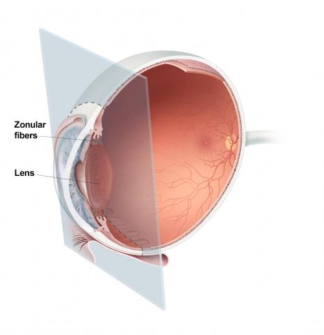 image tagged with zonular, zonule, marfan syndrome, lens, zonular fibers