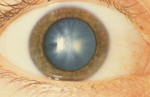 image tagged with cataracts, white congenital cataract