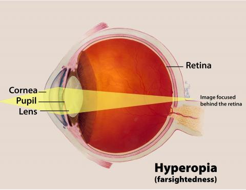 image tagged with farsightedness, infographic, illustration, eye, labels, …;