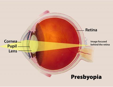 image tagged with cornea, infographic, age-related, lens, loss, …;