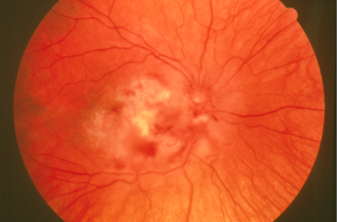 image tagged with eye infection, eye, cmv retinitis, retinal disease, microscopic, …;