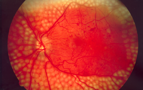 image tagged with diabetic retinopathy, eye disease, microscopic, science, microscope, …;