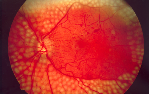 image tagged with scatter laser surgery, fundus