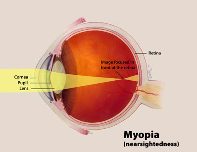 image tagged with labels, nearsighted, pupil, cornea, illustration, …;