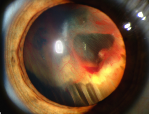 image tagged with eye, science, close, vitreous hemorrhage, retina, …;