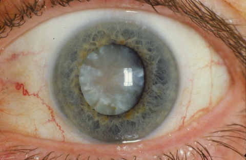 image tagged with cataract