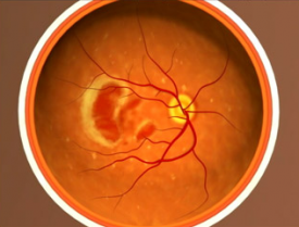 image tagged with microscopic, age-related macular degeneration, microscope, science, eye disease, …;