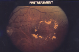 image tagged with diabetic macular edema
