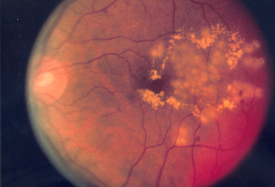 image tagged with diabetic retinopathy, focal laser surgery