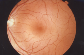 image tagged with anatomy, retina, eye, vision, optic disc, …;