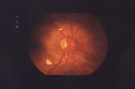 image tagged with diabetic retinopathy, proliferative retinopathy