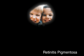 image tagged with lens, smiling, eye, retina, retinitis pigmentosa, …;