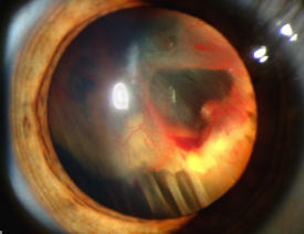 image tagged with retinal detachment, eye, vitreous hemorrhage, vision, retina, …;