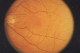 image tagged with retina, retinopathy